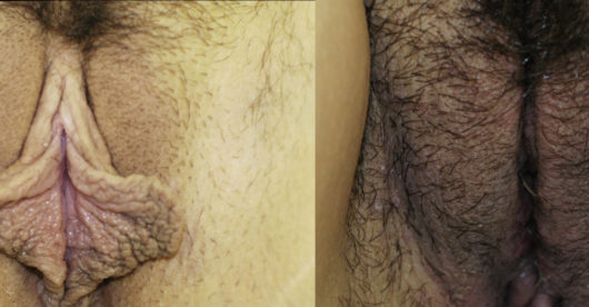 Labiaplasty before and after
