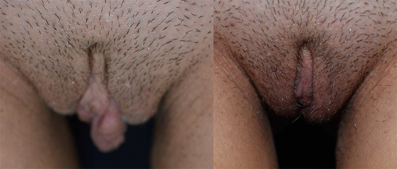 Labiaplasty before and after