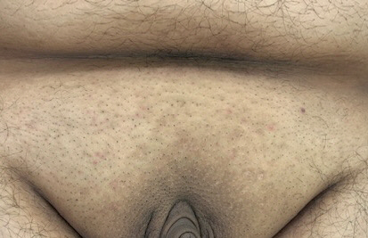 FUPA or Monds Pubis with excess skin and fat