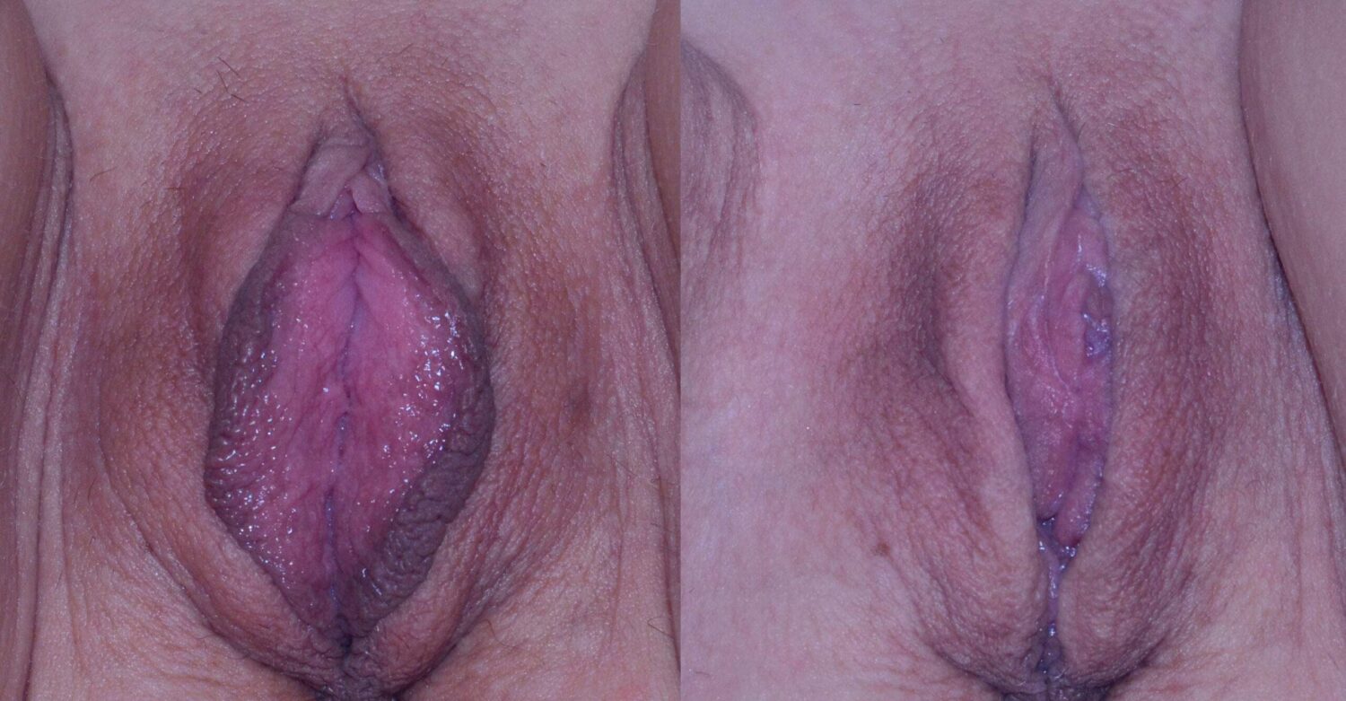 Labiaplasty Before and after