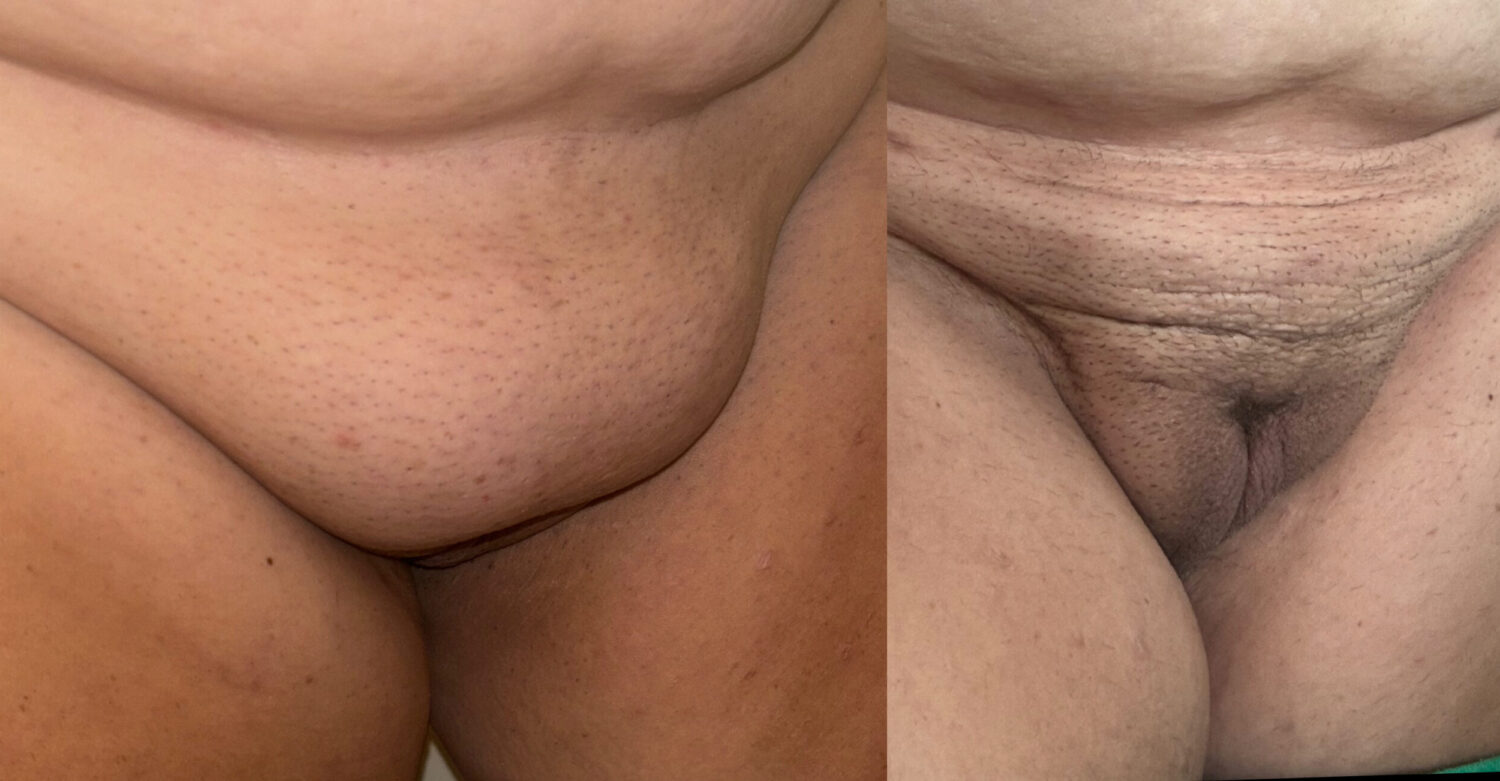 before and after correction of FUPA fat in upper ;ubic area